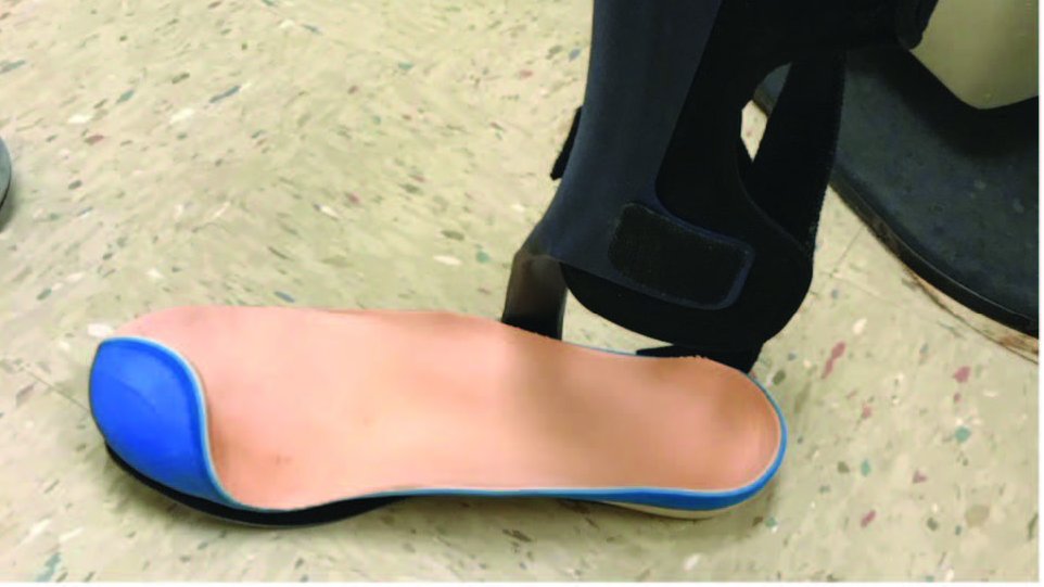 PodiatryToday's tweet photo. Read "Conservative Care Considerations For Partial Foot Amputation In Patients With Diabetes," by Jakob C. Thorud, DPM, MS, FACFAS and Patrick Flanagan, CO, MBA, FAAOP.
https://t.co/Z9uYHBFWUy
@APMA @ACFAS @APMSAtweets https://t.co/vXfZdJZlJQ