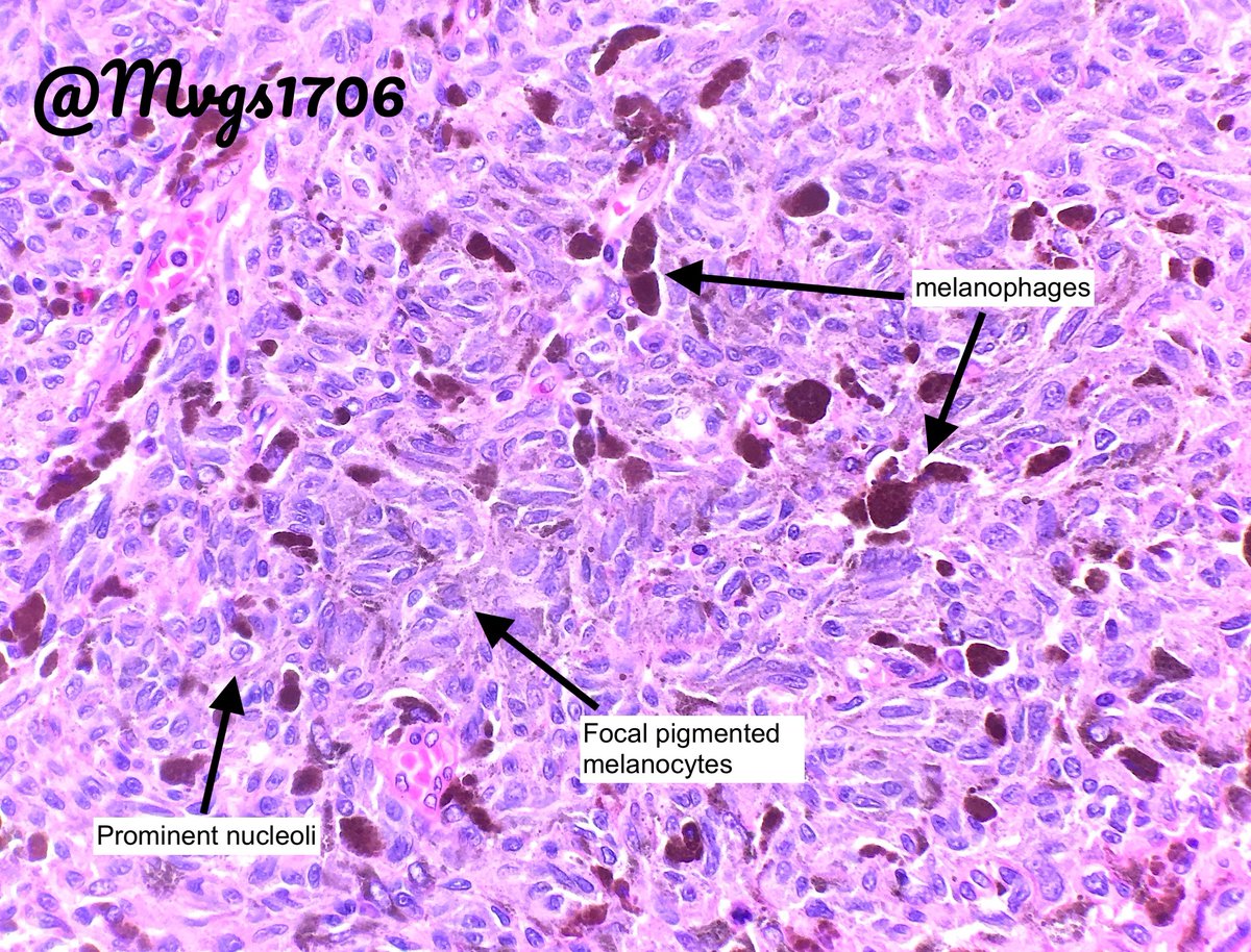 Anal mucosal melanoma: Nodular/polypoid growth Often amelanotic No UICC staging Molecular – No UV signature BRAF mutations less common ~10% KIT, SF3B1, ATRX, TP53, ARID2, SETD2 Poor prognosis/survival #GIpath