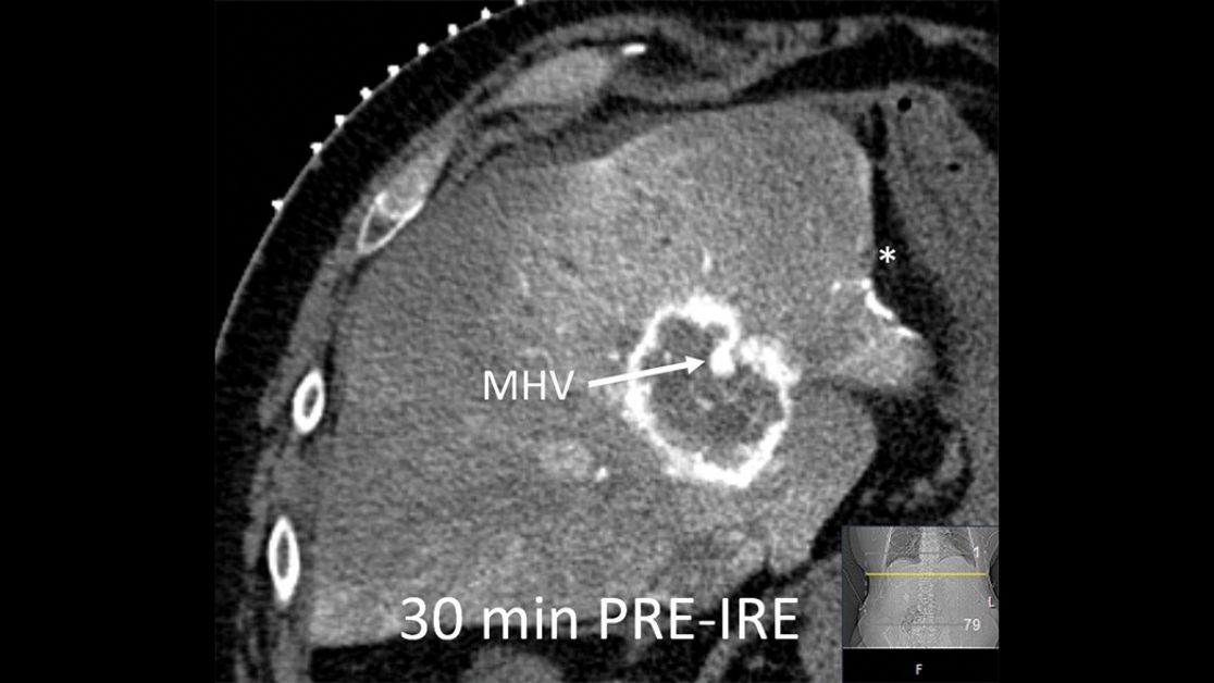 Radiology (@radiology_rsna) on Twitter photo Irreversible electroporation was effective and relatively safe for treatment of colorectal liver metastases less than or equal to 5 cm unsuitable for resection and thermal ablation. bit.ly/3tFYsxB <a href="/MartijnMr/">Martijn Meijerink</a> <a href="/amsterdamumc/">Amsterdam UMC</a> #IRRad #InterventionalRadiology Irreversible electroporation was effective and relatively safe for treatment of colorectal liver metastases less than or equal to 5 cm unsuitable for resection and thermal ablation. bit.ly/3tFYsxB <a href="/MartijnMr/">Martijn Meijerink</a> <a href="/amsterdamumc/">Amsterdam UMC</a> #IRRad #InterventionalRadiology