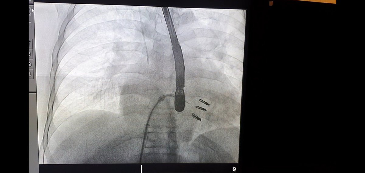 Marco Alcantara (@alcantaracardio) on Twitter photo Finally we could 3d print echo data for complex #mitraclip planning!!!! Thanks to #MatthewJolly and <a href="/lassoan/">Andras Lasso</a> for the great resources available in the #heartslicer github!!! Made a true difference! Great team work! <a href="/modanira/">Julieta Morales P.</a> <a href="/MuratallaMD/">ROBERTO MURATALLA MD</a> <a href="/DeeDeeWangMD/">Dee Dee Wang MD</a> Finally we could 3d print echo data for complex #mitraclip planning!!!! Thanks to #MatthewJolly and <a href="/lassoan/">Andras Lasso</a> for the great resources available in the #heartslicer github!!! Made a true difference! Great team work! <a href="/modanira/">Julieta Morales P.</a> <a href="/MuratallaMD/">ROBERTO MURATALLA MD</a> <a href="/DeeDeeWangMD/">Dee Dee Wang MD</a>