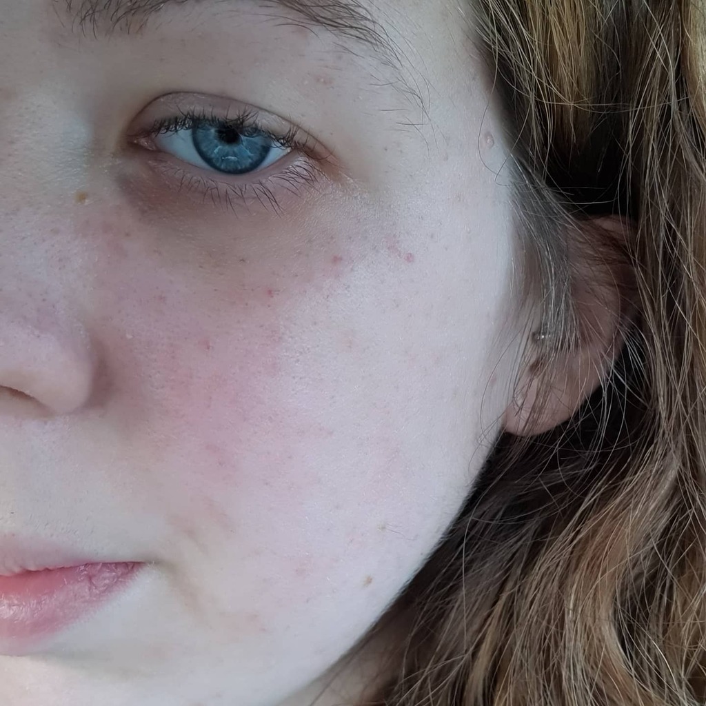 My veins started bursting round my eyes and on my face years ago when I was vomiting a lot 
Unfortunately now all it takes is for me to cry, strain slightly, rub my eyes too rough or anything really
I don't know why it happens so easily but it's definite… instagr.am/p/CMnUJxpDXSS/