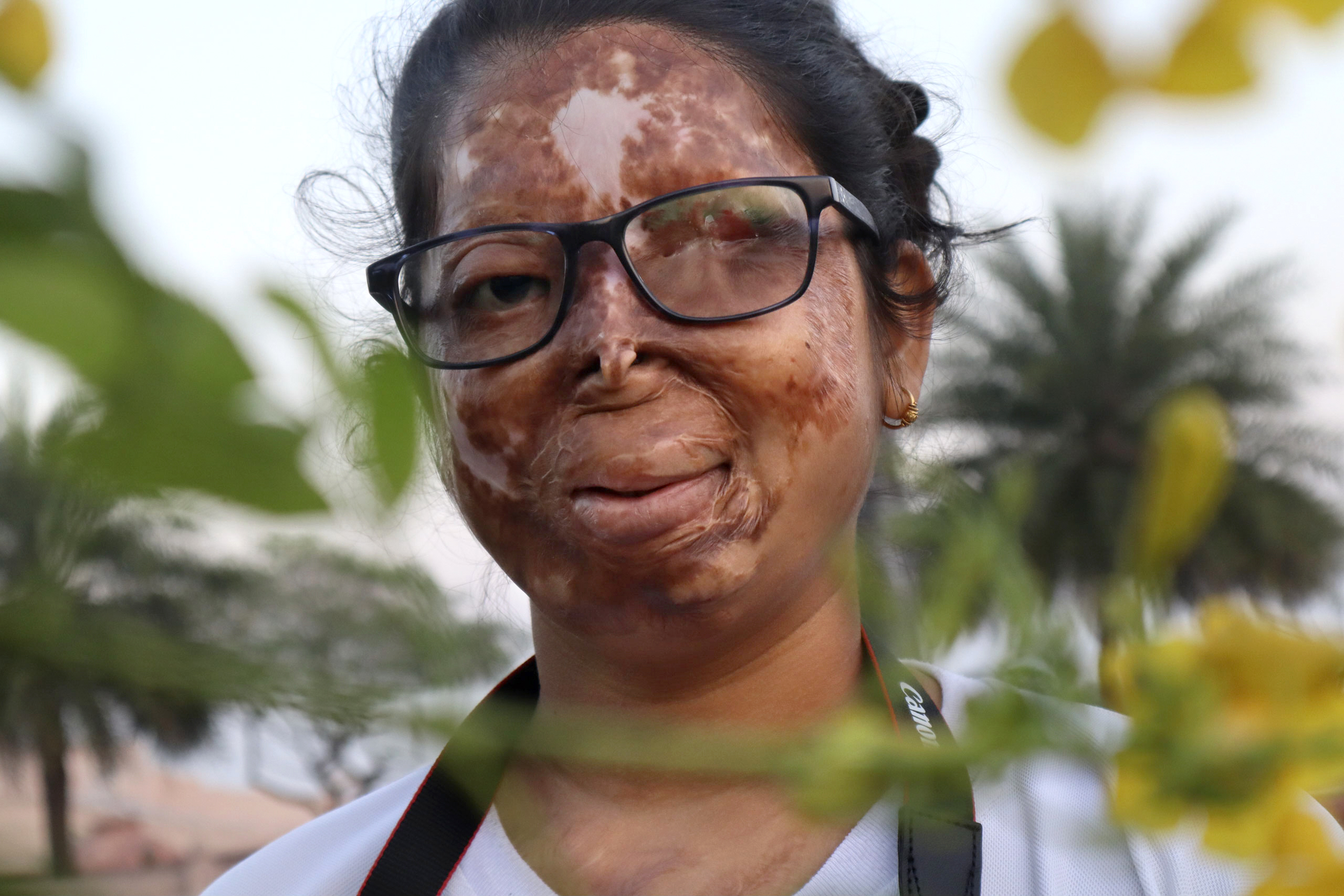 Anshu: Finding the lost identity after acid attack