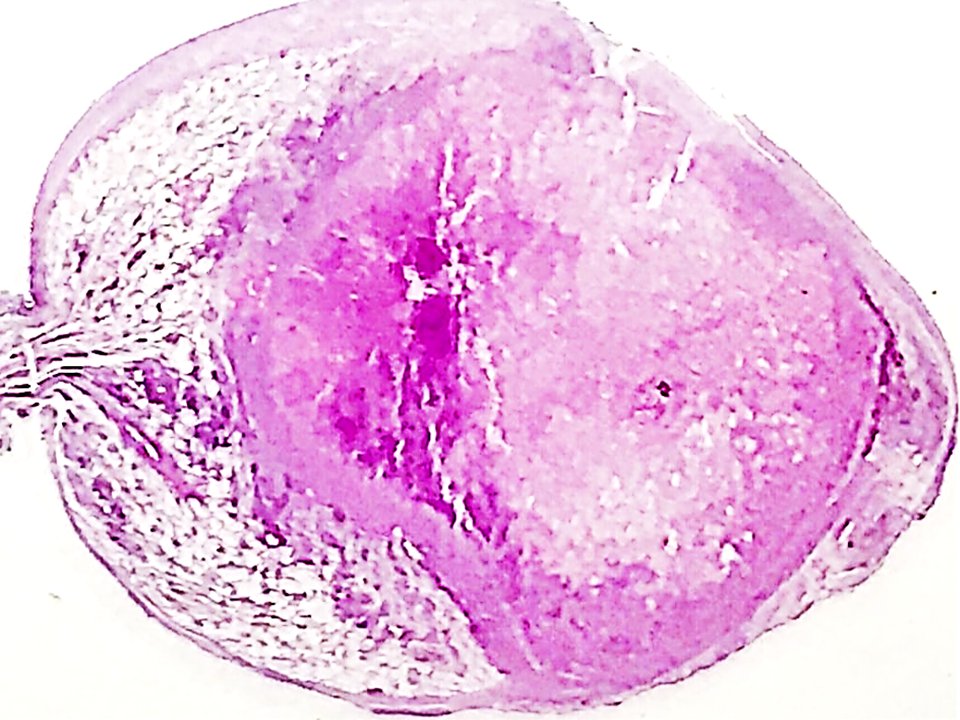 PathologySp's tweet photo. 58 y/o male, dog breeder with a solitary pulmonary nodule that mimics lung cancer. https://t.co/PmVVHyursw