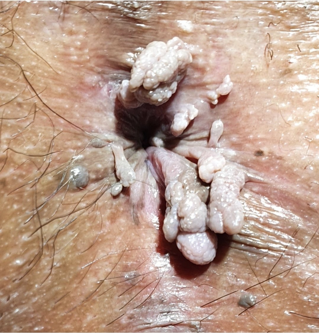 JBSANTOSMD2's tweet photo. Daily self inspection and checking yourself if you are active for #HPV #ANOGENITALWARTS
@CouragePinas https://t.co/rLApJIOY77