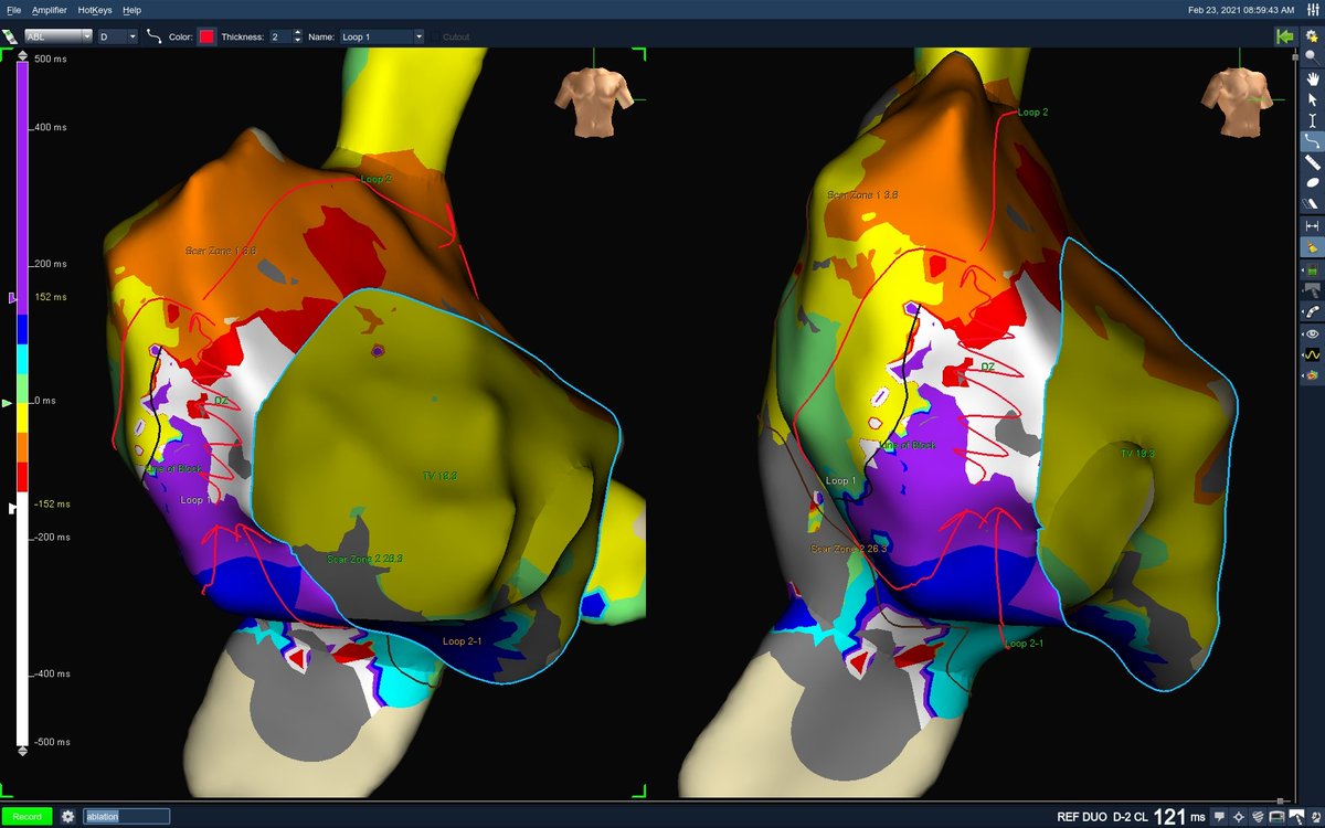mhdawada_'s tweet photo. I had the pleasure to support Dr. @AbiSalehBernard at @AUBMC_Official for a right sided double-loop atrial flutter (30 years post atriotomy)

Termination during ablation achieved by #Tacticath_SE catheter on the critical isthmus.

#abbott #epeeps #healthcare https://t.co/EAmi7jbg7A