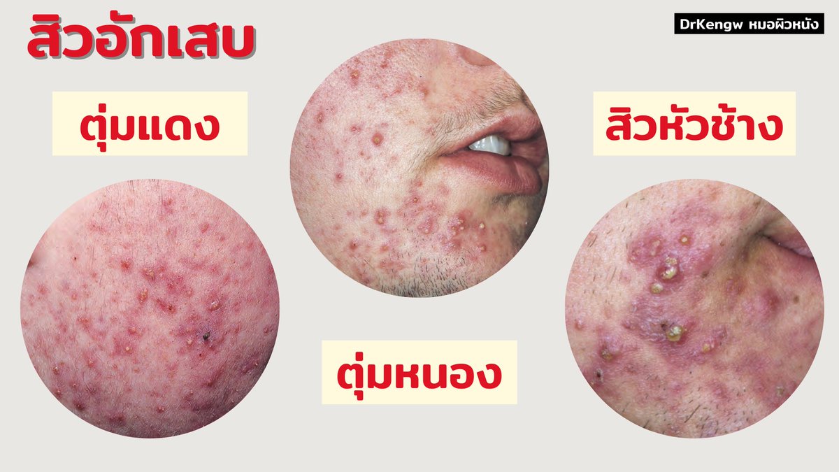 เรื่องของผิว by Kengw on Twitter: เรื่องของผิว By Kengw On Twitter: