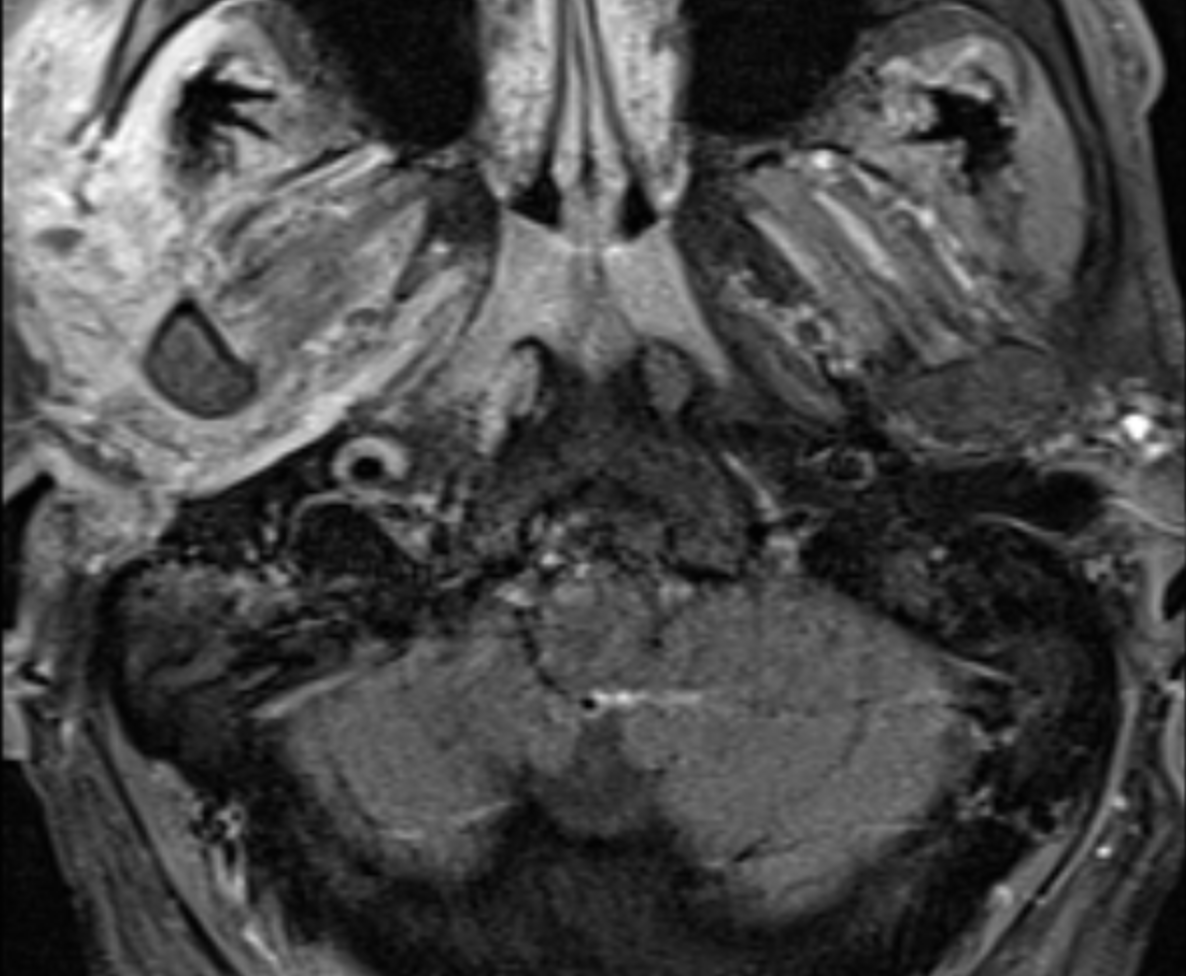 UMaryland Neuroradiology tweet media