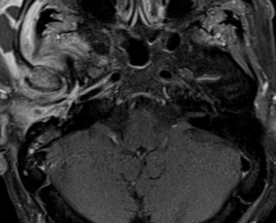 UMaryland Neuroradiology tweet media