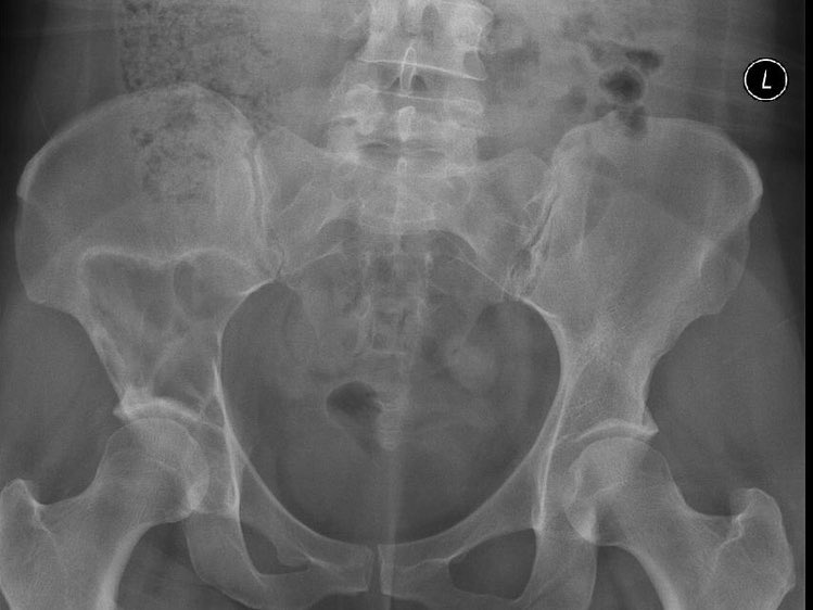 Having a rare bone condition is frustrating but since finding out about my condition, Fibrous Dysplasia I now understand my body better than I ever have done. The pictures are my first infusion Aug 2020 and an X-ray which shows my tumour in my pelvis #rarebones <a href="/FDysplasia/">FD/MAS Alliance</a>