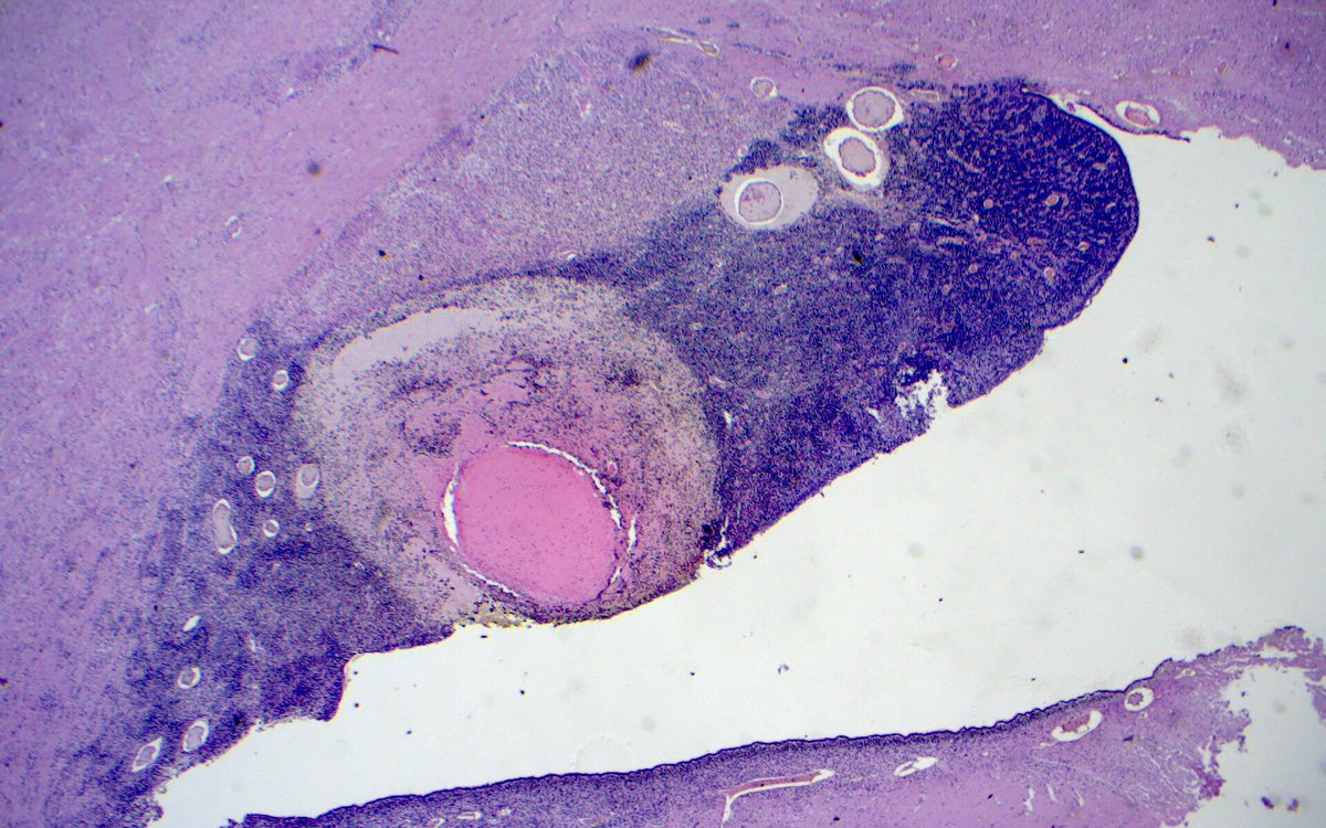 Premature #fetalbrain with subependymal germinal matrix hemorrhage over the head of the #caudate nucleus. Etiologies include rich vascularity with immature capillaries and systemic hypoxia. #neuropath #neurotwitter #Neurology #autopsy #perinatalpath #PathTwitter #MedEd #pedpath