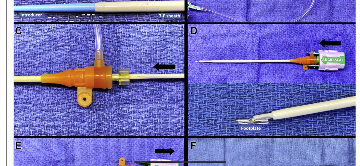 FelixValencia10's tweet image. “The Art of the Seal”sciencedirect.com/science/articl…

Delivering Angioseal trough 7 Fr sheath, when advancing its delivery sheath not possible 
#CathLabHack in #JACCinterventions by @arunothayaraj &amp;amp; colleagues
