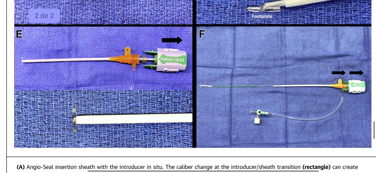 FelixValencia10's tweet image. “The Art of the Seal”sciencedirect.com/science/articl…

Delivering Angioseal trough 7 Fr sheath, when advancing its delivery sheath not possible 
#CathLabHack in #JACCinterventions by @arunothayaraj &amp;amp; colleagues