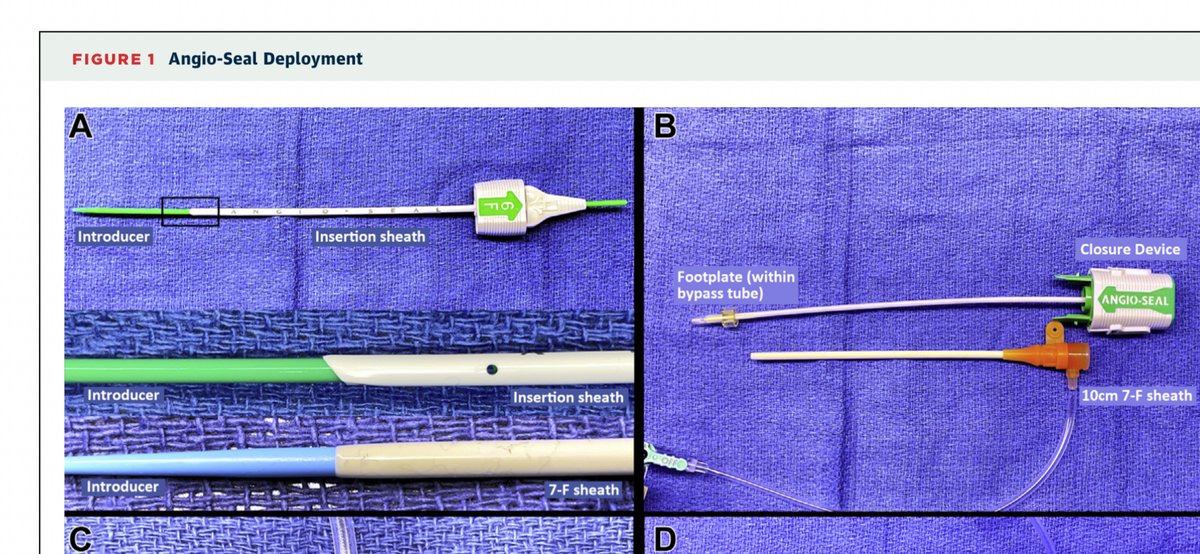 FelixValencia10's tweet image. “The Art of the Seal”sciencedirect.com/science/articl…

Delivering Angioseal trough 7 Fr sheath, when advancing its delivery sheath not possible 
#CathLabHack in #JACCinterventions by @arunothayaraj &amp;amp; colleagues