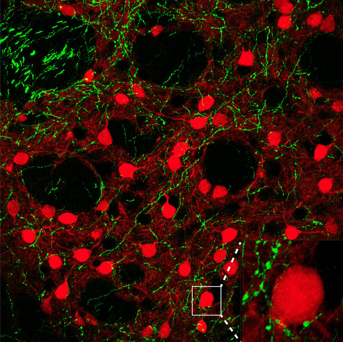 SinaiBrain's tweet photo. VOTE NOW for @NeuroSwatiG's & @cristufer13's #ArtoftheBrain image #15: "Neuronal Chatter" - Visualizing neuronal communication: arriving green cortical processes onto red striatal #neurons in the #brain. Remember👉Most♥️'s wins! #BAW2021 #SinaiBAW @dana_fdn #BensonLab https://t.co/If7jV23jHr