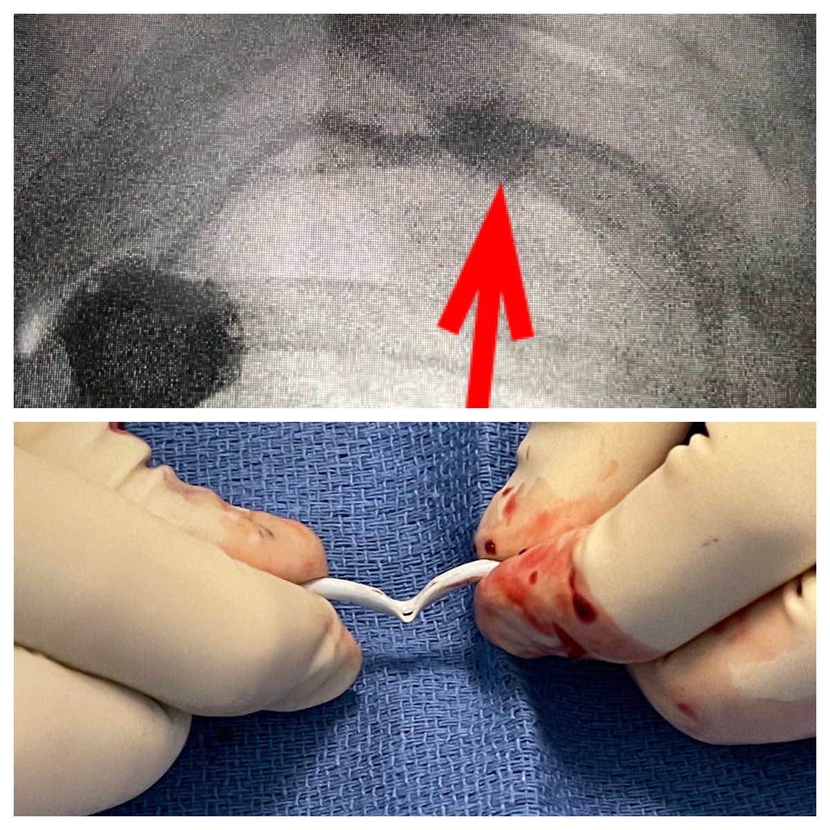Ambarish Bhat (@bhat_ambarish) on Twitter photo Despite its reputation for malfunction subclavian ports are being placed with impunity! Classic “pinch-off”. This port did not last even one month🤦🏽♂️😡<a href="/SIR_ECS/">SIR ECS</a> <a href="/SIRRFS/">SIR RFS</a> <a href="/radRounds/">radRounds Radiology Network</a> <a href="/CAIRweb/">Canadian Association for Interventional Radiology</a> <a href="/TraineesBSIR/">BSIR Trainees (British Society of IR Trainees)</a> . Despite its reputation for malfunction subclavian ports are being placed with impunity! Classic “pinch-off”. This port did not last even one month🤦🏽♂️😡<a href="/SIR_ECS/">SIR ECS</a> <a href="/SIRRFS/">SIR RFS</a> <a href="/radRounds/">radRounds Radiology Network</a> <a href="/CAIRweb/">Canadian Association for Interventional Radiology</a> <a href="/TraineesBSIR/">BSIR Trainees (British Society of IR Trainees)</a> .