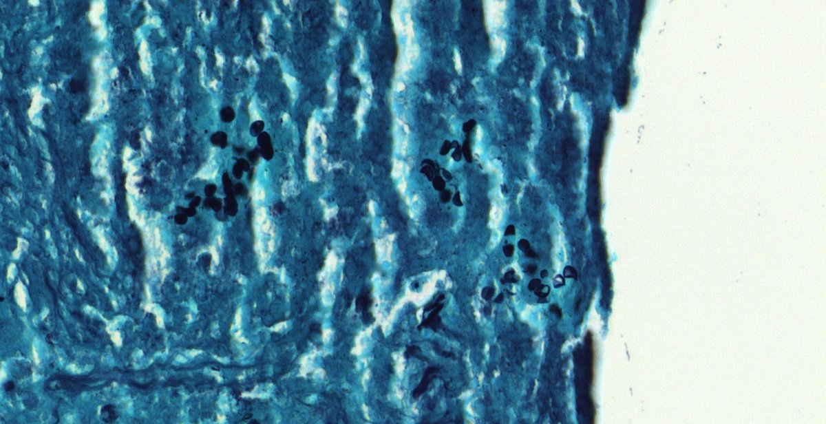SansanoValero's tweet photo. Same culprit 3 diseases. Do you know his name? #pulmpath #Pathbugs #crittersontwitter

@_Romo_Navarro @Oliviermm @lourdesalazarh @LNaranjoRA @EduDacostaE @SofaMelgar2 @XaviAraMancebo @CarmenAlGi @EvaCamFu @ChrisyCarito @AnasChCh https://t.co/VxIHyAtxUF