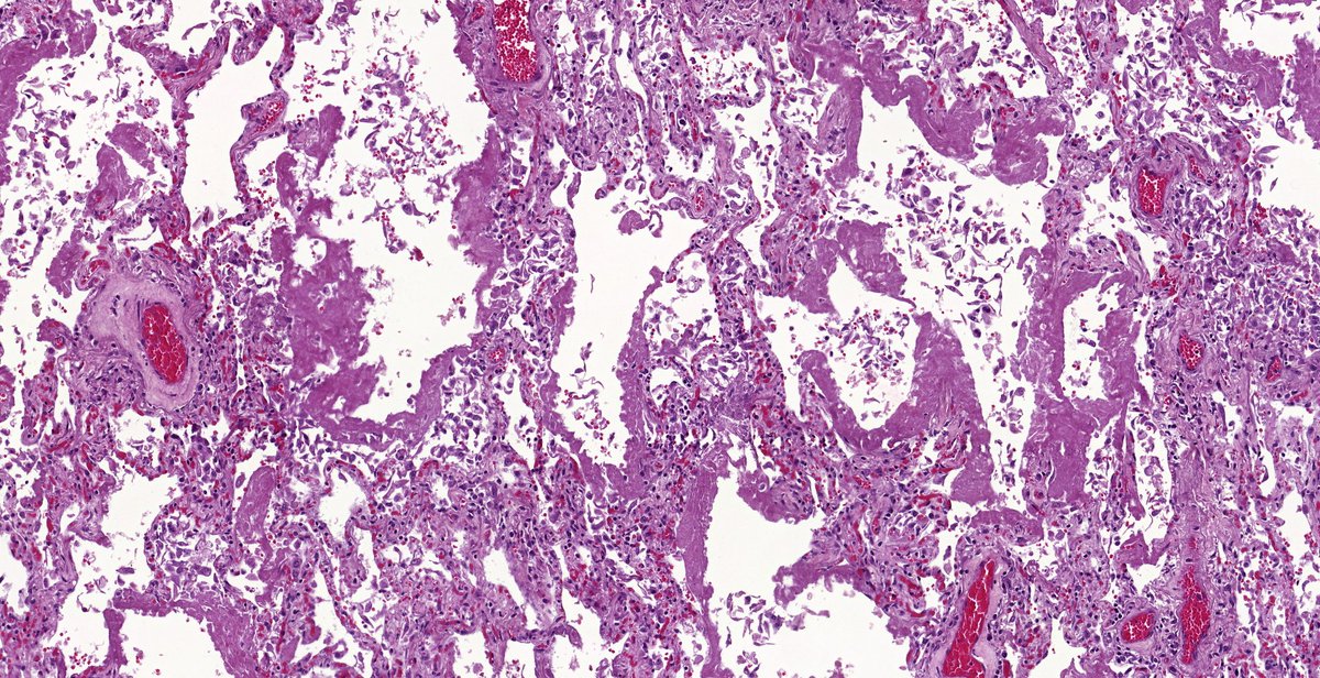 SansanoValero's tweet photo. Same culprit 3 diseases. Do you know his name? #pulmpath #Pathbugs #crittersontwitter

@_Romo_Navarro @Oliviermm @lourdesalazarh @LNaranjoRA @EduDacostaE @SofaMelgar2 @XaviAraMancebo @CarmenAlGi @EvaCamFu @ChrisyCarito @AnasChCh https://t.co/VxIHyAtxUF