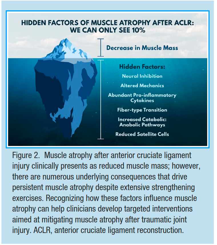 Muscle Atrophy After ACL Injury: 
Implications for Clinical Practice

👀👀👇👇
pubmed.ncbi.nlm.nih.gov/32866081/