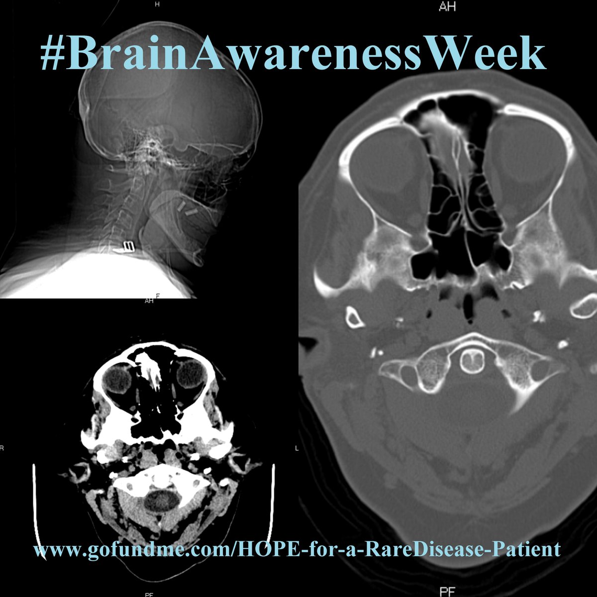 RarePatient's tweet photo. #BrainAwarenessWeek2021 
#BrainAwarenessWeek #BrainWeek

https://t.co/vMaqlrceXh

#EhlersDanlosSyndrome #CervicalInstability #IntracranialHypertension #CSFLeak #Hydrocephalus #EaglesSyndrome #ChiariMalformation #98thPercentile #Synesthesia

#Neurosurgery
💔https://t.co/IZvd6VzgOY https://t.co/xKyhq5kxd2