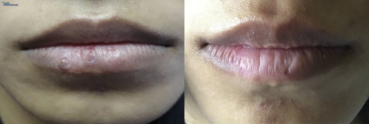 Pulsed dye laser for verrucae in Asians—a retrospective review bit.ly/3tPWETo