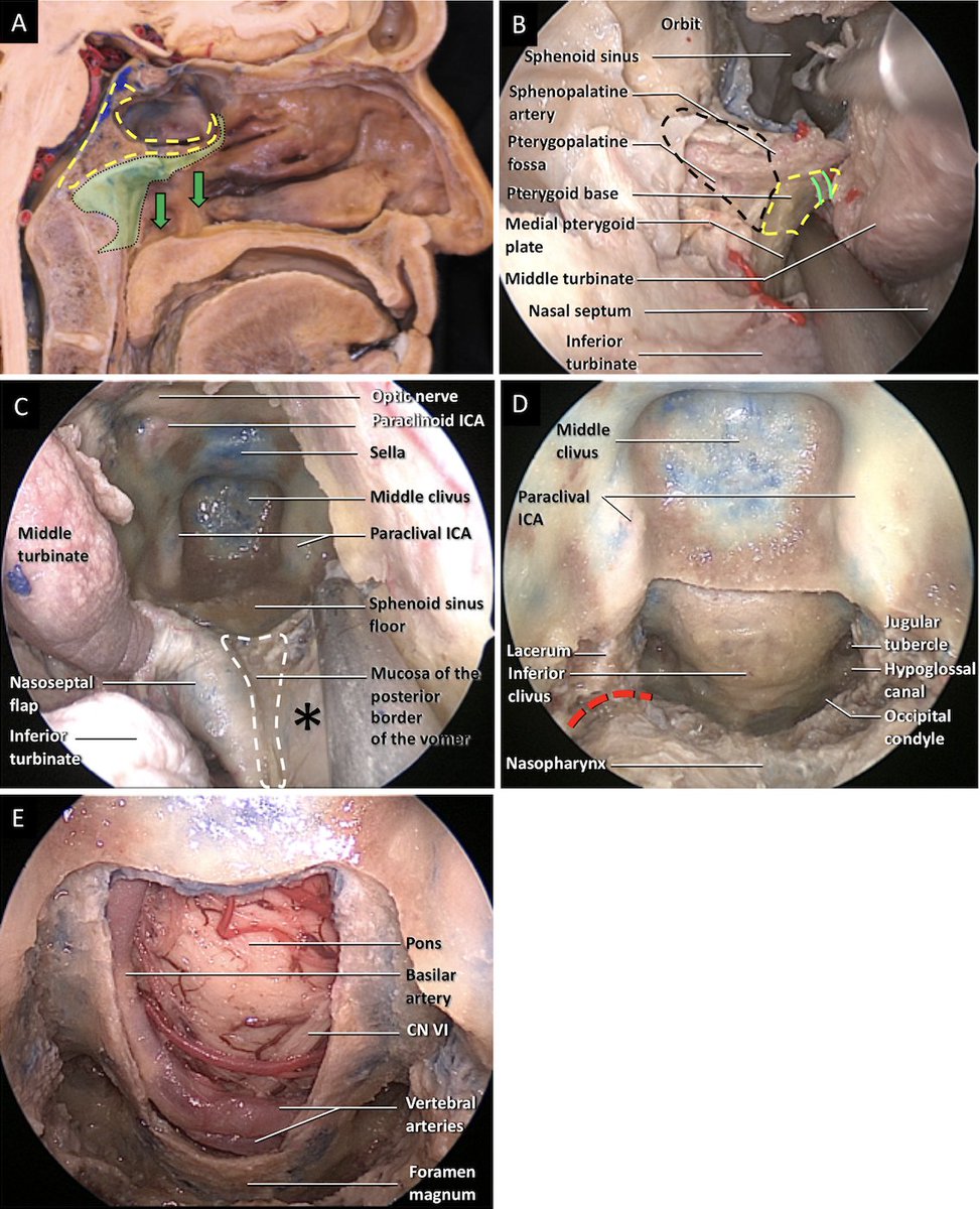 Carlos Pinheiro-Neto, MD PhD (@dr_pinheiro) on Twitter photo Paper just accepted for publication in the JNLS-B Skull Base. Total clivectomy with complete nasopharyngeal preservation. Stay tuned! #NasalPreservation in #SkullBaseSurgery #chordoma <a href="/MayoClinicENT/">Mayo Clinic ENT</a> <a href="/PerisCelda/">Maria Peris-Celda, MD PhD</a> Paper just accepted for publication in the JNLS-B Skull Base. Total clivectomy with complete nasopharyngeal preservation. Stay tuned! #NasalPreservation in #SkullBaseSurgery #chordoma <a href="/MayoClinicENT/">Mayo Clinic ENT</a> <a href="/PerisCelda/">Maria Peris-Celda, MD PhD</a>