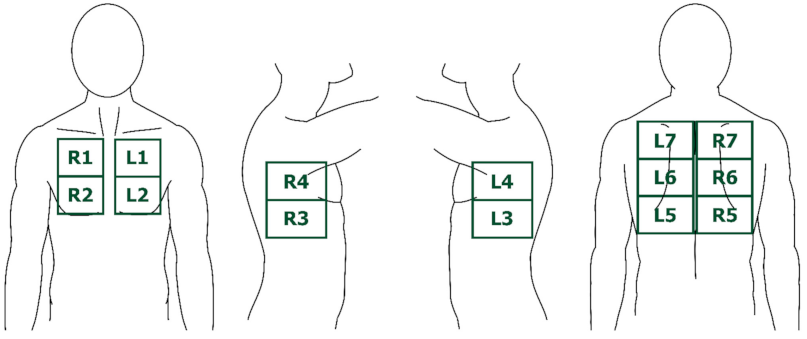 JCM_MDPI's tweet photo. #mdpijcm
#NewArticle: Lung Ultrasound to Phenotype Chronic Lung Allograft Dysfunction in Lung Transplant Recipients. A Prospective Observational Study
More at: https://t.co/Lpgq4ofwa5
#lungtransplantation
#bronchiolitisobliteranssyndrome #chroniclungallograftdysfunction https://t.co/opccZfxJwh