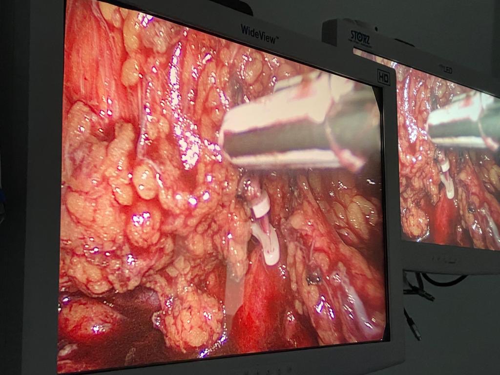 Nefrectomia simple laparoscópica 

Femenino 46 años, DM + Obesidad IMC 35.1 + Dislipidemia. Hidronefrosis izquierda c/2500cc de contenido.
#laparoscopy #UroSoMe