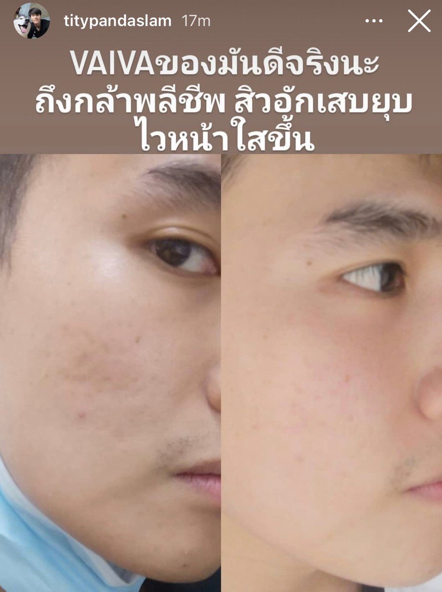 sndnas's tweet photo. เอารีวิวมาฝากอีกแล้วค่าา สาวๆหนุ่มๆ
วิตามินที่ดีที่สุดในตอนนี้!!!!
รอยสิว รอยแผล สีผิว ให้เห็นชัดๆกันไปเลยย ไม่ต้องเลเซอร์ ไม่ต้องฉีด💉
📮ส่งฟรีตั้งแต่กล่องแรก เซ็ตทดลอง 690฿
#vaiva #pichlook https://t.co/J5GJ832Pub
