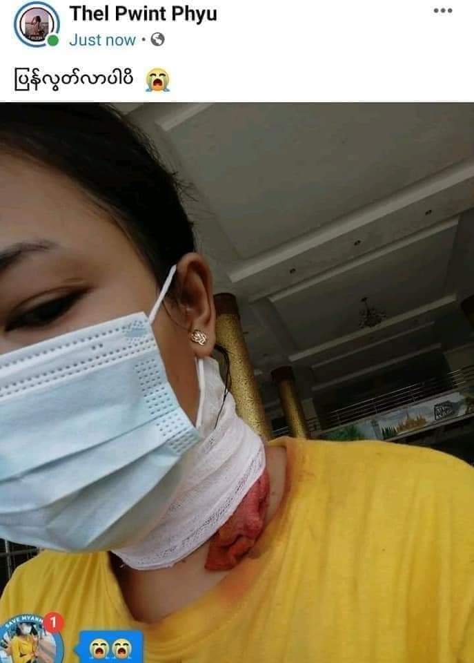 Myeik 9.3.2021 Arrested near the new block
 White Sand House has arrived
 Rubber bullet wounds to the neck are not uncommon
 He was shot in the neck
 I am a student from Myeik University
Tw//violence
#WhatsHappeningInMyanmar 
#Mar9Coup
