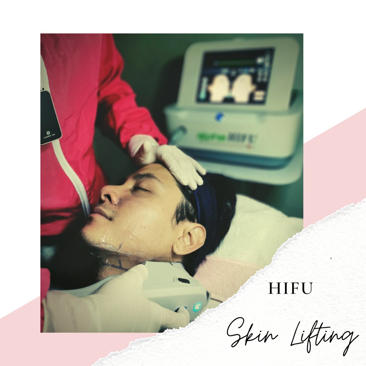theclinicave's tweet photo. @qaloyJCsantos tries the High Intensity Focused Ultrasound, commonly known as 𝗛𝗜𝗙𝗨. 

It is one of your non-surgical option for achieving a tighter &amp; more contoured face!

Msg us for more information on our Skin Lifting &amp; Anti Aging packages.

09173038027
#Skin #Laser #Clinic https://t.co/aYF7vDeF16