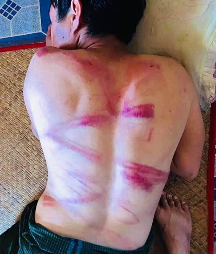 tw // wound 
On March 9, in Myeik township this morning, young protesters were detained and beaten with motorcycle chains by the Myanmar Junta's Police.

#Mar9Coup
#WhatsHappeningInMyanmar
#OpCCP