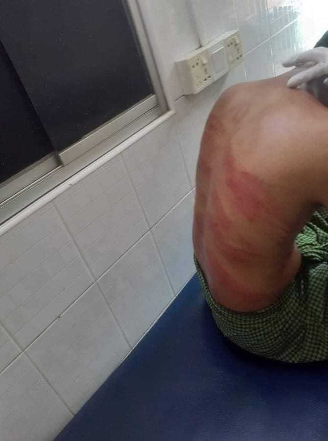 tw // wound
RELEASE THE ARRESTED 
Although students from Myeik were released students were tortured while they were arrested.
#WhatsHappeningInMyanmar #Mar9Coup #OpCCP