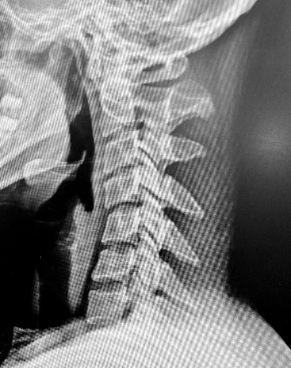 목뼈가 역C자로 굽었으나 근육이 버텨줘서 디스크가 안눌리는 기적의 거북목