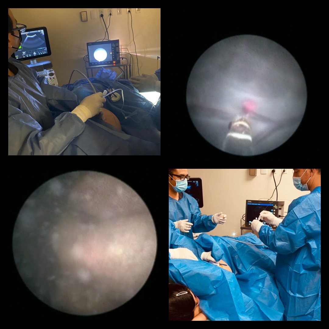 TTTS and placental laser 09 March 2021.
#PrenatalMx #iberoamericanresearchnetwork #fetalsurgery #fetalmedicine