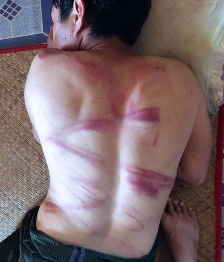 #Mar9Coup Myeik.  Daily arbitrary arrests and beatings continue.  This man beaten with chains. 

#WhatsHappeningInMyanmar