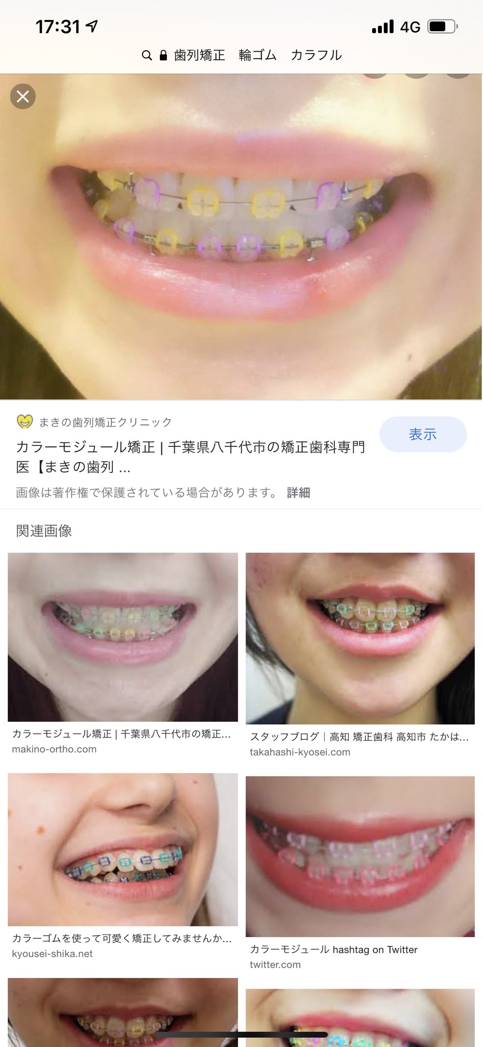 金井 歯列矯正の装置につけるカラフルな輪ゴムつけたい どこで買えるんですか Twitter
