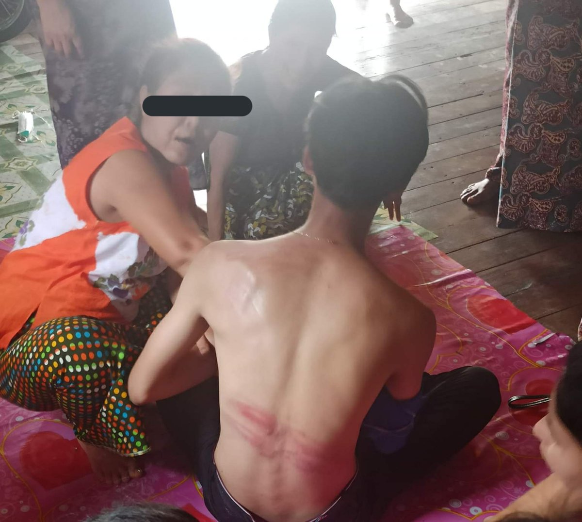 Some of the protesters who got arrested in Myeik, Myanmar was released today. They were brutally tortured in prison.Terrorists even beat him with Chains.Their brutality is out of control. 
Tw : wound and blood  
<a href="/freya_cole/">Freya Cole</a> <a href="/RapporteurUn/">UN Special Rapporteur Tom Andrews</a>
#WhatsHappeningInMyanmar #Mar9Coup