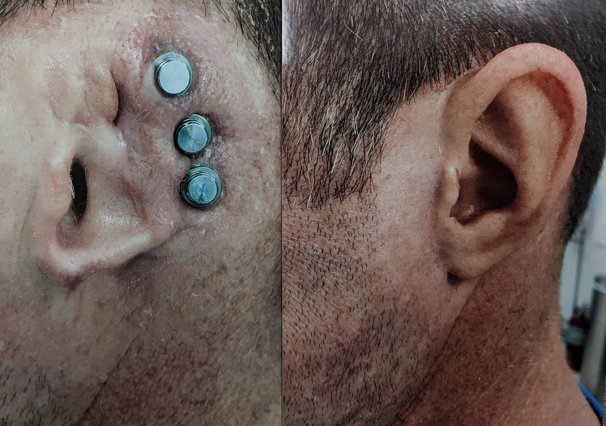 Detachable prosthetic ear sculpted by Curt Risinger (FB: bit.ly/3qBNreM). Painted by his boss. #Prosthetic #CraftYourFandom