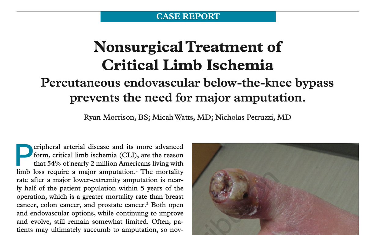 Check out this DETOUR like procedure using off-the-shelf equipment from @MdPetruzzi and <a href="/Watts_IR/">Mike Watts</a>! A PTFE conduit bypassed the proximal SFA -&gt; femoral vein -&gt; popliteal vein -&gt; posterior tibial vein -&gt; into the PTA bit.ly/30qVArD 

<a href="/AMI_Vascular/">Vascular Institute of Atlantic Medical Imaging</a> <a href="/SIRRFS/">SIR RFS</a> <a href="/SIRspecialists/">Society of Interventional Radiology</a>