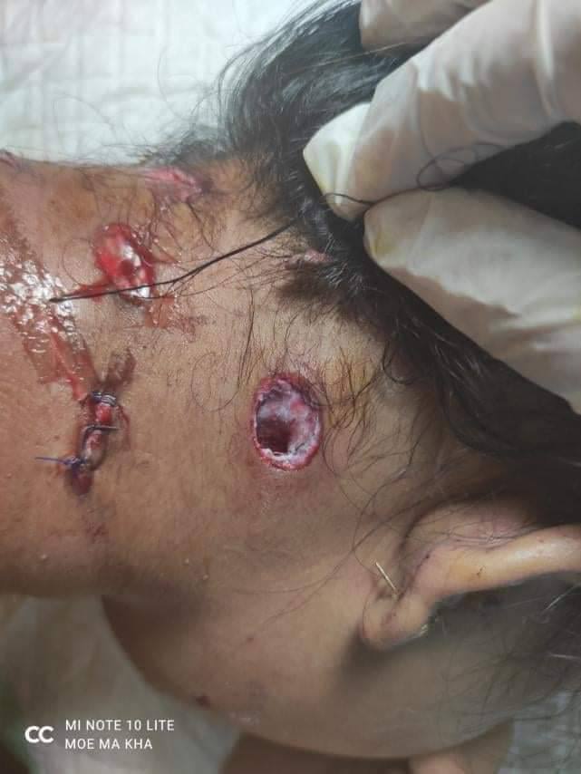 AungHeinMin17's tweet photo. tw//Wound Gunshot//Violence
Another protester woman from Myeik university areested this morning was released with rubber bullet wound in the neck. Imagine the cruelly of junta terrorists.
RELEASE THE ARRESTED
@UNHumanRights
#OpCpp
#Mar9Coup 
#WhatsHappeningInMyanmar https://t.co/s84Acw6aR5