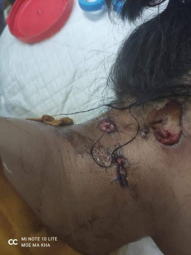 AungHeinMin17's tweet photo. tw//Wound Gunshot//Violence
Another protester woman from Myeik university areested this morning was released with rubber bullet wound in the neck. Imagine the cruelly of junta terrorists.
RELEASE THE ARRESTED
@UNHumanRights
#OpCpp
#Mar9Coup 
#WhatsHappeningInMyanmar https://t.co/s84Acw6aR5