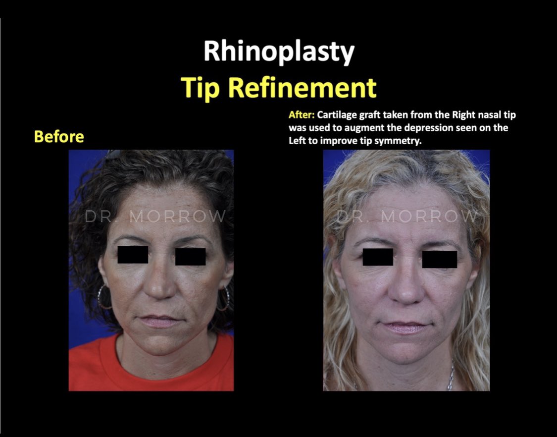 TomorrowsFace's tweet photo. #rhinoplasty #tiprefinement #beforeafter #facialplasticsurgery #drmorrow @TomorrowsFace https://t.co/PcnEkcKLvM