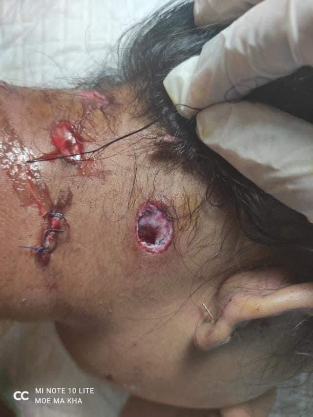 TW // Blood Wounds 
What’s Happening in Myeik ? Today the demonstrators at Myeik got arrested and they’re brutally tortured in jail by the before releasing them . Last person is a girl whose neck got purposely shot with a rubber bullet .  #March9Coup #WhatsHappeningInMyanmar