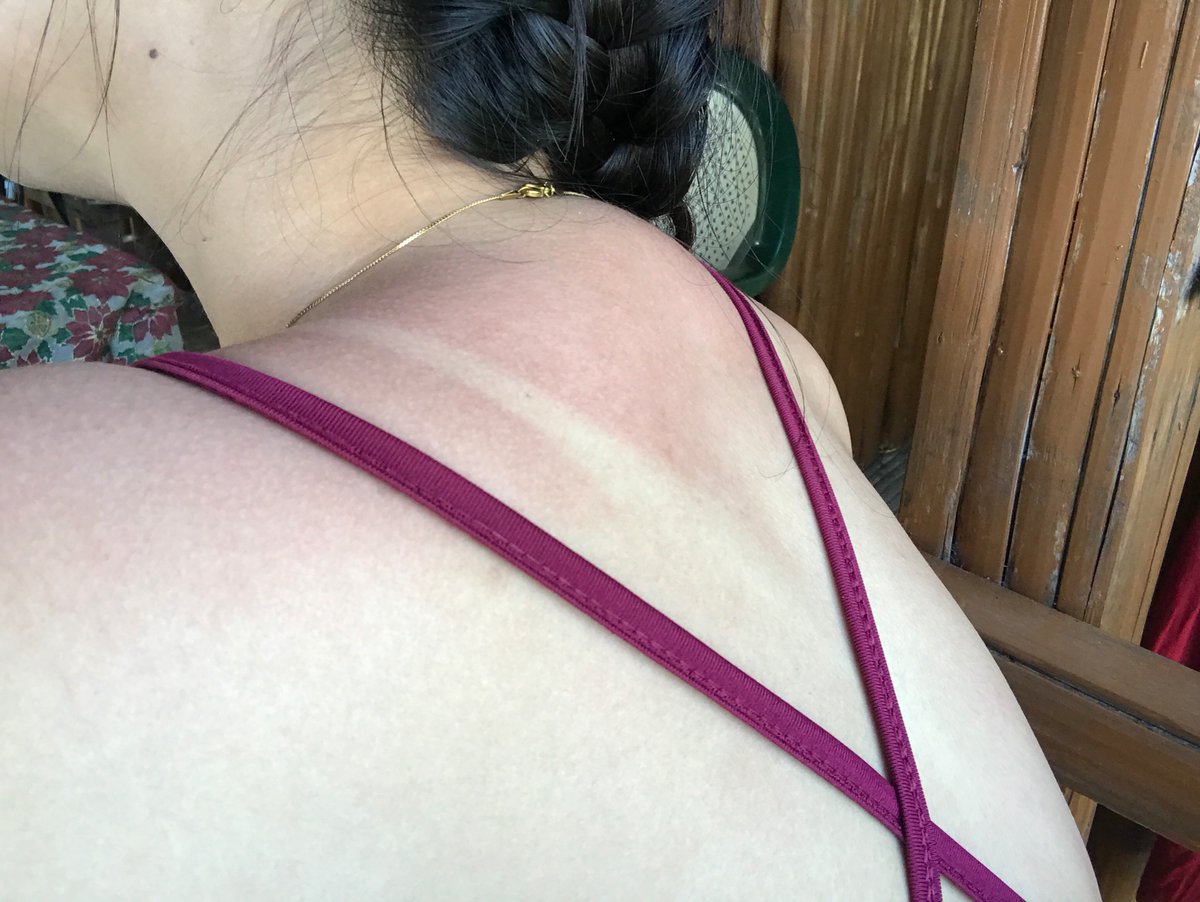 odrnktrna's tweet photo. Wag talaga kalimutan ang sunblock 🤦🏽‍♀️ Sunburn is real https://t.co/uN0K741wMP