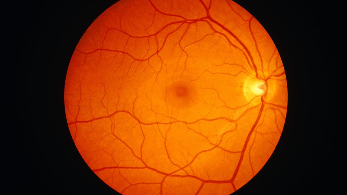 Eran Halperin (@halperineran) on Twitter photo I am excited to share our deep learning approach Sliver-Net <a href="/Nature_NPJ/">npj Journals</a> Digital Medicine - used for automatic detection of age-related macular degeneration (AMD) biomarkers using OCT scans. go.nature.com/3qyXMI6 with <a href="/DohenyEye/">Doheny Eye Institute</a> <a href="/rakotesh/">Nadav Rakocz</a> <a href="/njchiang/">Jeff Chiang</a> Vas Sadda I am excited to share our deep learning approach Sliver-Net <a href="/Nature_NPJ/">npj Journals</a> Digital Medicine - used for automatic detection of age-related macular degeneration (AMD) biomarkers using OCT scans. go.nature.com/3qyXMI6 with <a href="/DohenyEye/">Doheny Eye Institute</a> <a href="/rakotesh/">Nadav Rakocz</a> <a href="/njchiang/">Jeff Chiang</a> Vas Sadda