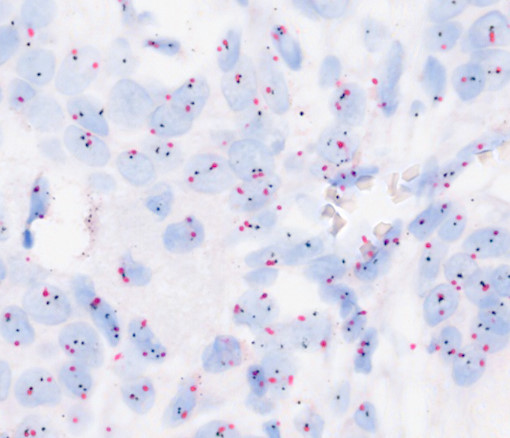 RocheDiaUSA's tweet photo. You have this case of breast stained with VENTANA HER2 Dual ISH stain.
How many nuclei will you count for assessing HER2/Chr 17 ratio?
A. 20
B. 50
C. I don’t know
#tweetorialtuesday #IHCPath #RocheMSA #breastcancer https://t.co/14UlmgLaBE
