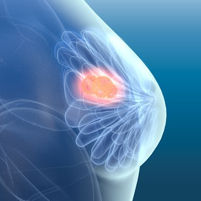 AuntMinnie's tweet photo. Variation in the assessment of breast density on mammograms was reduced with the use of an AI-based software application that enabled more consistent mammography reports. @CureMetrix @alyssa90266 #ImagingAI #ECR2021 #radiology  https://t.co/MKmvHLoqRr https://t.co/3tvJRFlcBh