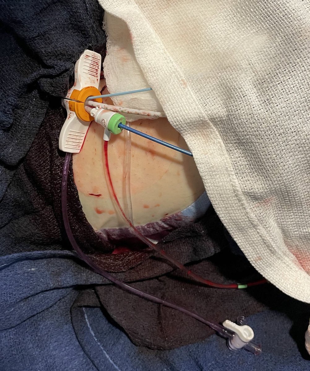 It’s TOIGHT! New meaning to single access for Impella supported LAD CTO with dual injections: 14F sheath, Impella, 4F diagnostic catheter, 6.5F sheath with 6F guide. <a href="/Ben_Kelemen/">Benjamin Kelemen</a> <a href="/goli_rahul/">Rahul Goli</a> <a href="/jlyang5/">Joseph Yang</a> @abiomedimpella