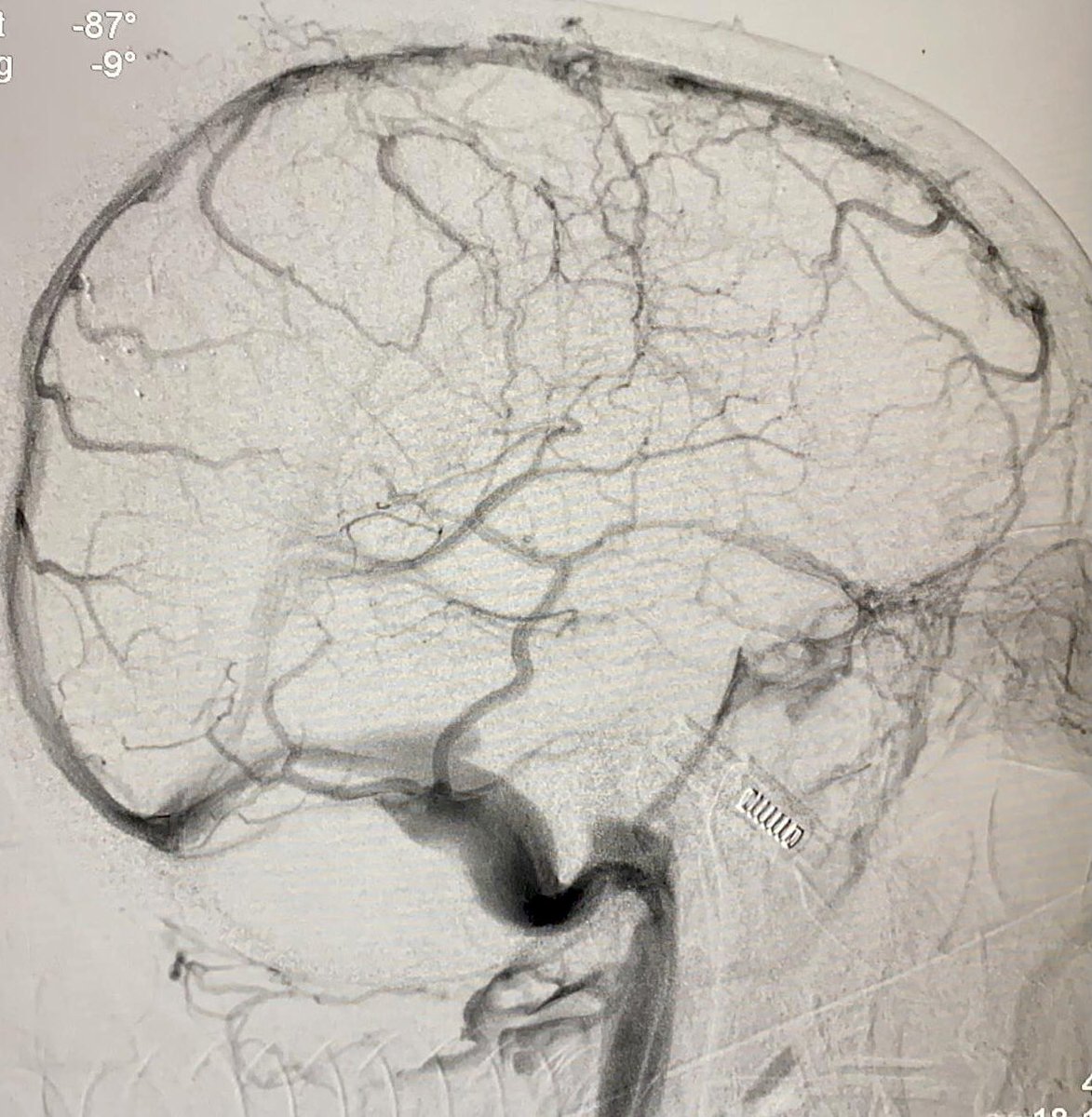 LuĂs H Castro-Afonso (@ikeafonso1) on Twitter photo Uncommon thrombectomy with stentriever as a rescue strategy for a thrombosis of the superior sagittal sinus refractory to anticoagulation. #thrombectomy <a href="/treatthestroke/">Treat The Stroke</a> <a href="/LINNConline/">LINNC online đ§ </a> <a href="/svinsociety/">SVIN</a> @SBDCV1 Uncommon thrombectomy with stentriever as a rescue strategy for a thrombosis of the superior sagittal sinus refractory to anticoagulation. #thrombectomy <a href="/treatthestroke/">Treat The Stroke</a> <a href="/LINNConline/">LINNC online đ§ </a> <a href="/svinsociety/">SVIN</a> @SBDCV1