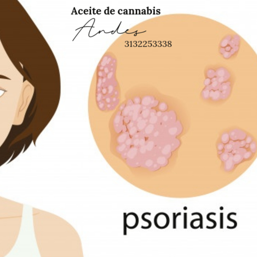 CannabisAndes's tweet photo. La #psoriasis cutánea que puede presentarse en individuos de distintas edades, se cree que uno de los factores que lo produce conlleva un trasfondo genético. Se conoce hoy que el uso de la crema de #CBD tienen un gran potencial para ayudar con esta condición. https://t.co/dXVaUg3417